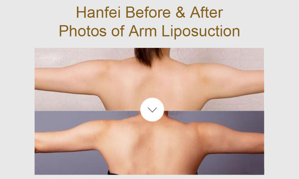 hanfei arms liposuction before & after